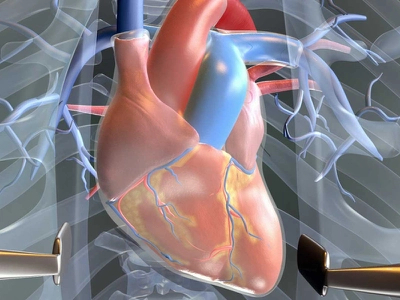 Heart Valve Replacement Surgery In UK